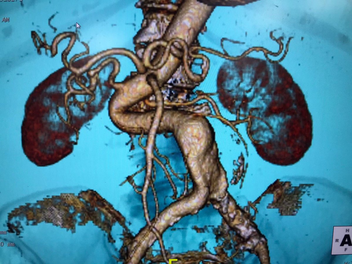 Está bastante difícil pasarse por un hospital para aclarar dudas de cara a la elección de plaza MIR. En #Angiologia y Cirugia #Vascular de #hospitalGregorioMarañon estamos encantados de intentar resolverlas: yo como tutor, o los residentes <a href="/elena_mmorales/">Elena Martín Morales</a> <a href="/alvaromocu/">Álvaro Moreno</a> 👍🏼
#MIR2020