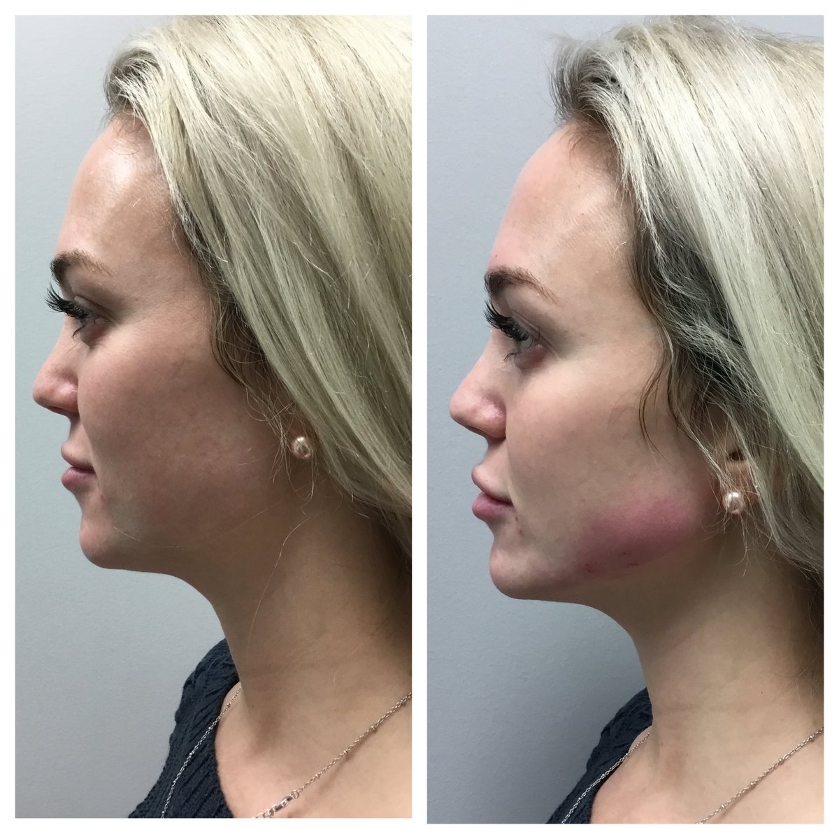 Jaw dropping results! 😍👊🏼 #JawlineFiller #ProfilePerfection #skinBeisLIFE #MondayMotivation #skinBeWIN