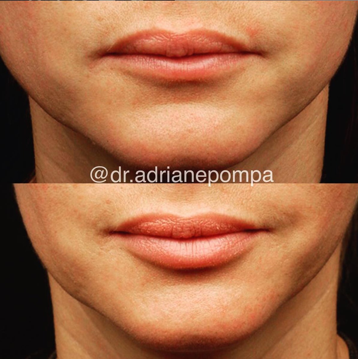Time to bring out the pout for #LipAppreciationDay! Check out mayoralderm.com for more information about our lip treatments. 👄 #MayoralDerm #LoveYourSkin #LoveYourLips