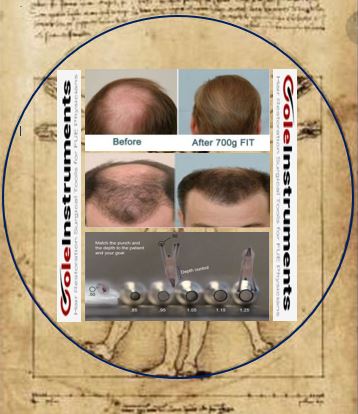 coleinstruments's tweet photo. Cole Instruments is ingenious quality that lasts over time!
CI punches for outstanding FUE hair transplants.
CI tools, best support for surgeons best results for their patients.
See: https://t.co/QuNuJV7wf0
#FUE #hairtransplant #punch #PCID #forhair #mPCID #CDD-Vortex https://t.co/VPNJiMvPwZ