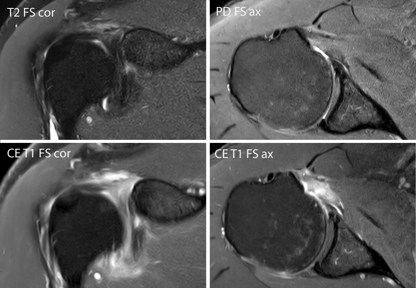 MRIESSENTIALS on Twitter "Adhesive capsulitis of the shoulder enhancement of the rotator