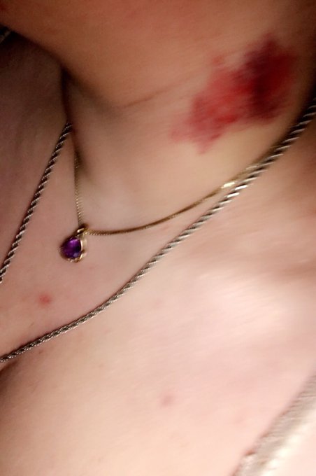 Hah... I've only turned this color in other places, I guess my neck was a fair champion in exchange for