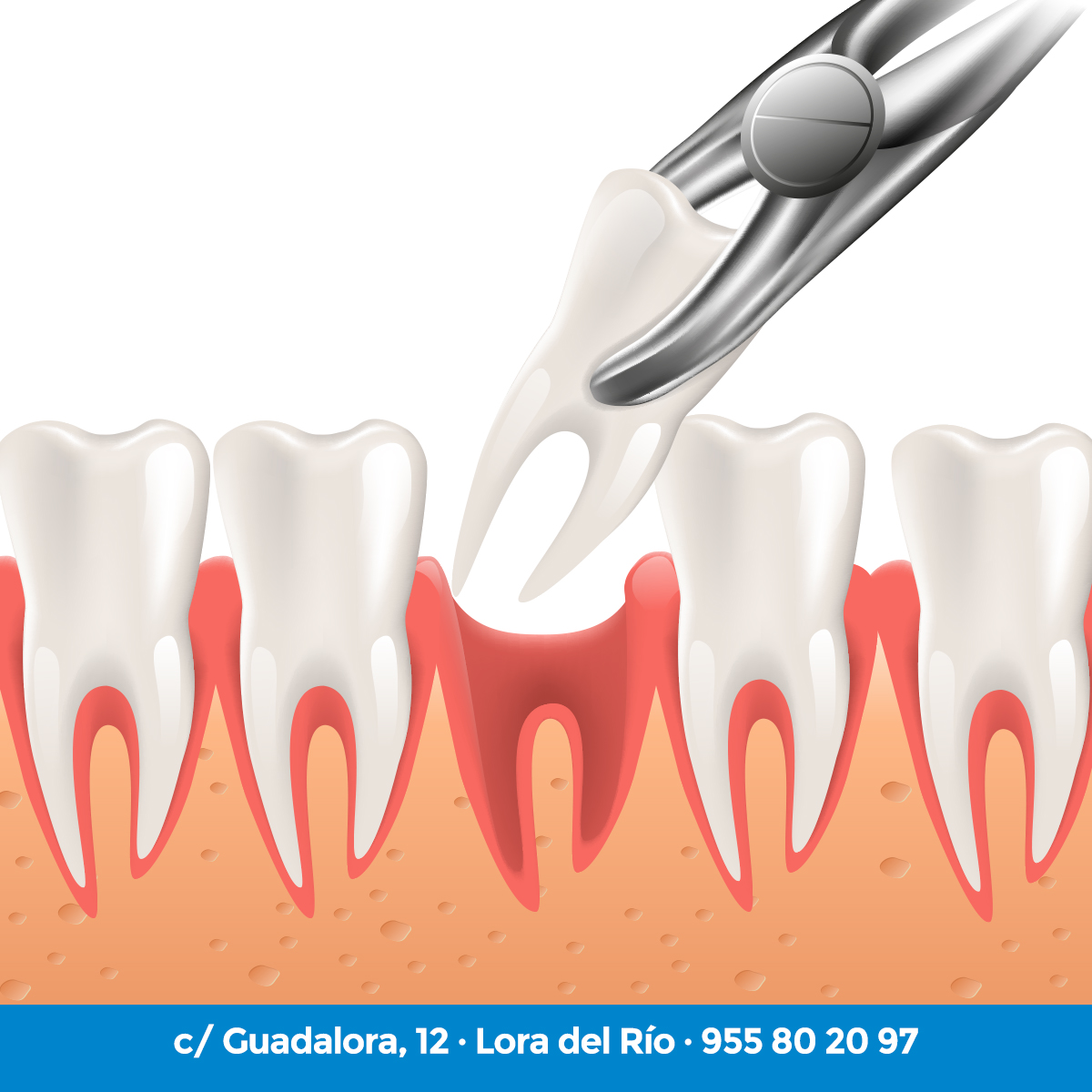 guadalora's tweet photo. ¿Necesitas la extracción de alguna pieza dental? ❗❗
☎LLámanos y programaremos un día para poder realizar dicho tratamiento👌☎️ 955 80 20 97
#cirugiadental #odontologiaguadalora #odontologiaguadalora https://t.co/9NZbjmdYJy