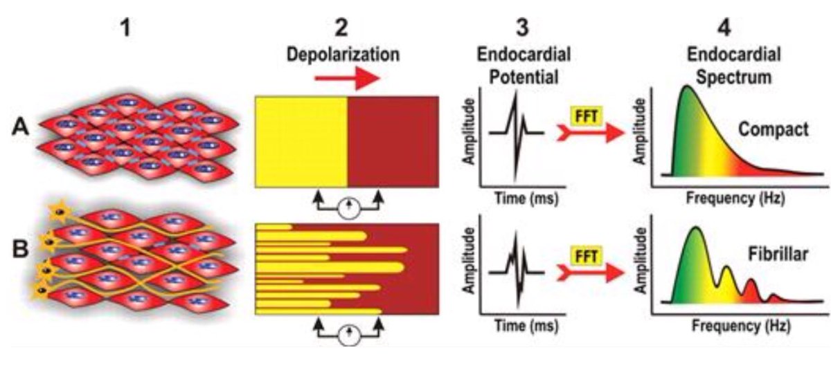 If you will use fragmanted EGMs as it suggested by our group, please remember you will see a high fragmantation in SN area due to the incursion of the nervous fibres into the SN myocardium(Fig1 by Pachon).Contrary to posteroseptal location of RSGP, SN is located anterolaterally