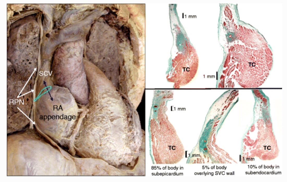 If you will use fragmanted EGMs as it suggested by our group, please remember you will see a high fragmantation in SN area due to the incursion of the nervous fibres into the SN myocardium(Fig1 by Pachon).Contrary to posteroseptal location of RSGP, SN is located anterolaterally