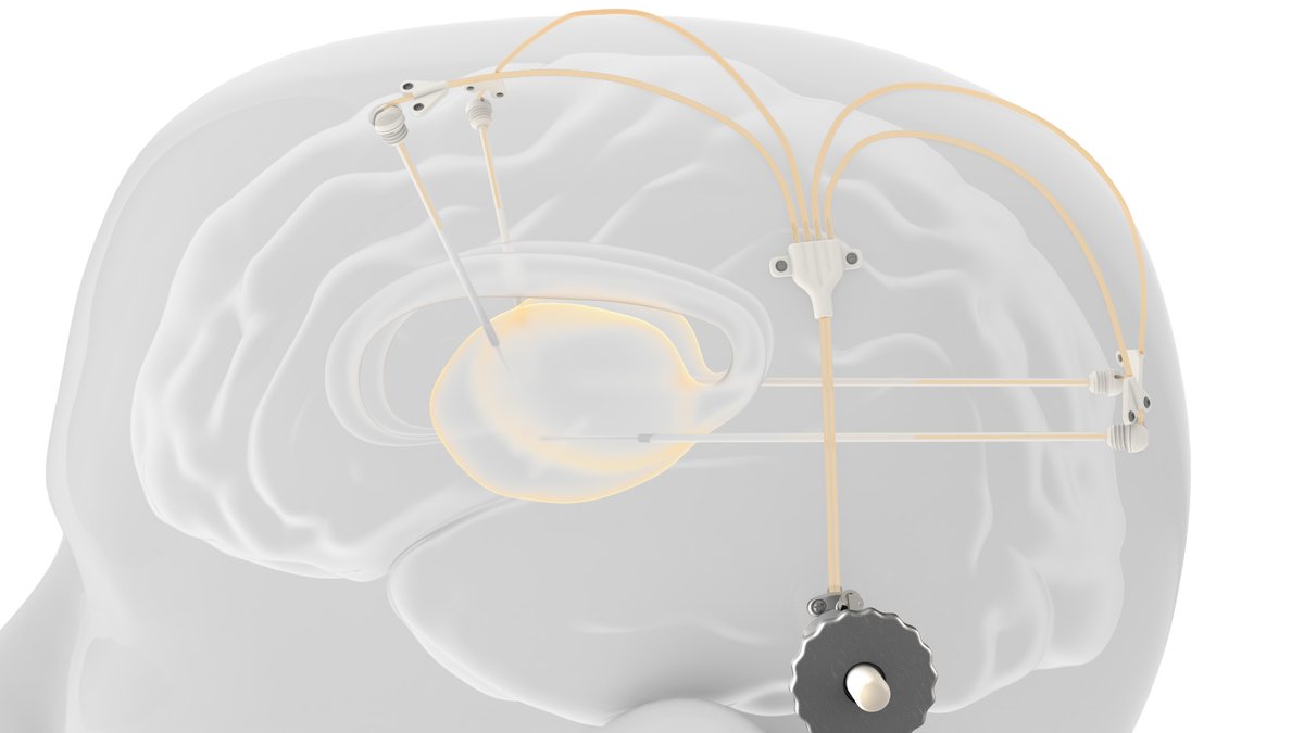 Our award-winning intraparenchymal drug delivery device, has played a critical role in a joint Phase 1-2 clinical study with <a href="/HerantisPharma/">Herantis Pharma</a> for the investigation of #CDNF as a treatment for #Parkinsons disease.
Read full press release here: bit.ly/3c5TYrT 
#drugdelivery
