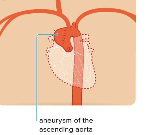 Cardiovasinv's tweet photo. #aortic aneurysm is a bulge or "ballooning" in a section of #Aorta. It causes #weakness in the wall of the aorta and increase the risk of #aortic rupture
For more information: https://t.co/gmKQaGgwnJ Ppaper submission: https://t.co/w4mJuy2Hkq https://t.co/izyUwPxmIr