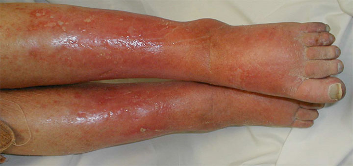 What’s causing your patient’s lower-extremity redness? ht.ly/ntBS30qqu0K
Learn clues to help you differentiate these conditions and identify the specific cause. 
#woundcare #skin #wounds #dermatitis #cellulitis #HCM