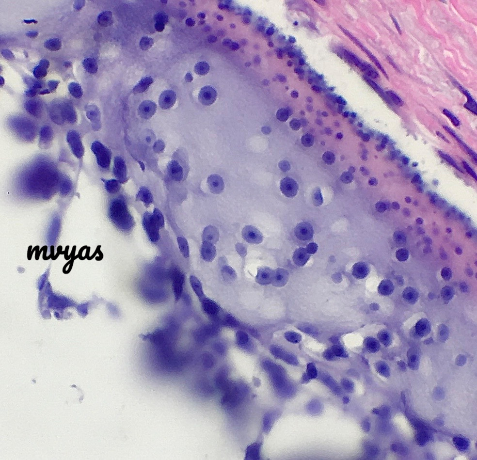 Mvgs1706's tweet photo. Interesting finding I thought fellow #pathnerds will enjoy!
Incidental finding in a hysterectomy for malignancy - what do you guys think?
#Gynpath #tooclosetodiagnose
Answer in the following thread https://t.co/kvKEzkXFHs