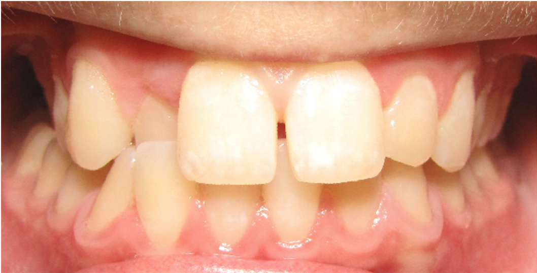 Check out this #TransformationTuesday featuring a male teenage patient whose results were achieved using <a href="/Invisalign/">Invisalign</a> 😁

If a straighter smile is something your teen desires, contact our office to learn how Invisalign can make that dream a reality! 705-444-1500 #beforeandafter