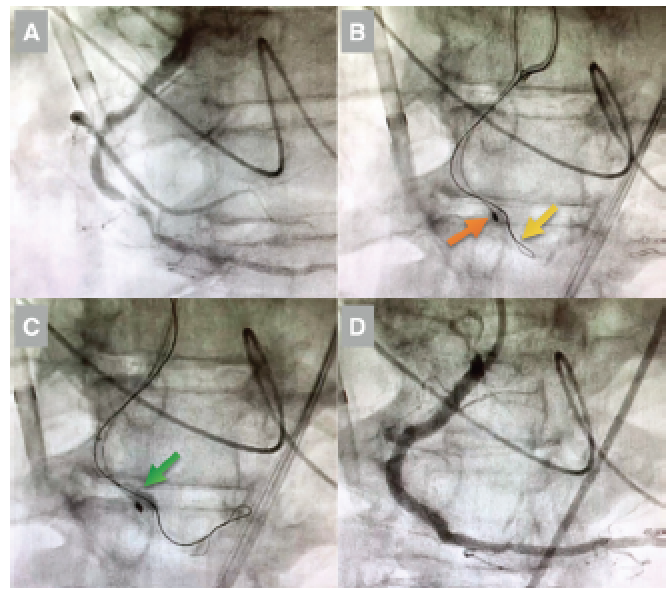 Journal of Invasive Cardiology tweet media