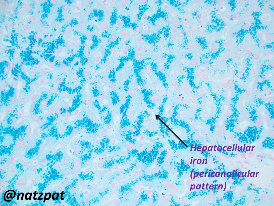 48 year old with elevated ferritin #liverpath #pathboards