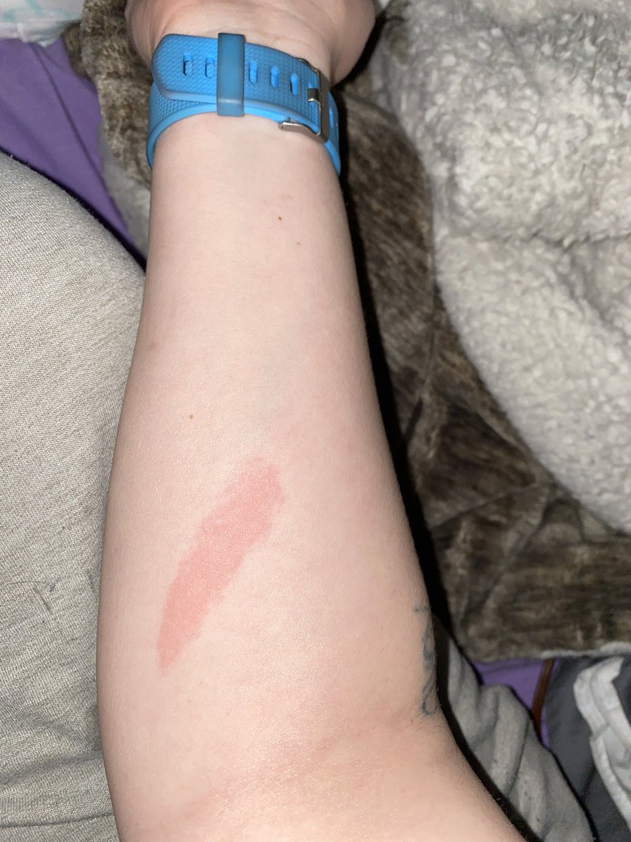 Day two update two: Tried to make real food on the stove and burnt the fuck out of my arm.