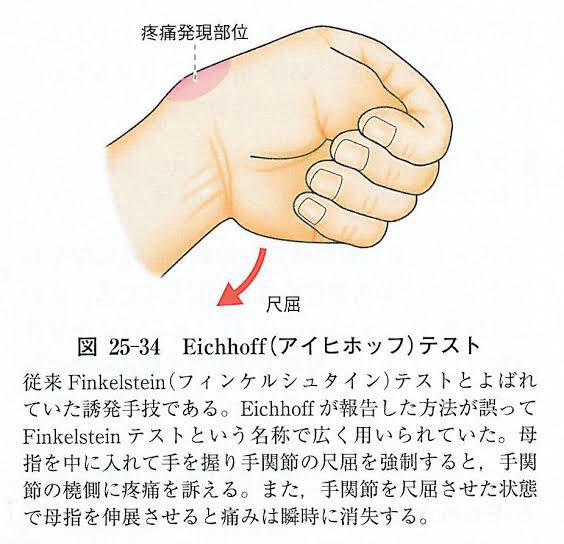 Alicerail スマホ音ゲー親指勢の方々 親指を内側にして手を握る その状態で手首を小指側に曲げる をやってみよう このとき赤くマーキングされた辺りが痛む人は親指の使いすぎで腱鞘炎になってるので手首と指を労りましょう 親指で極めるのもいいけど割と