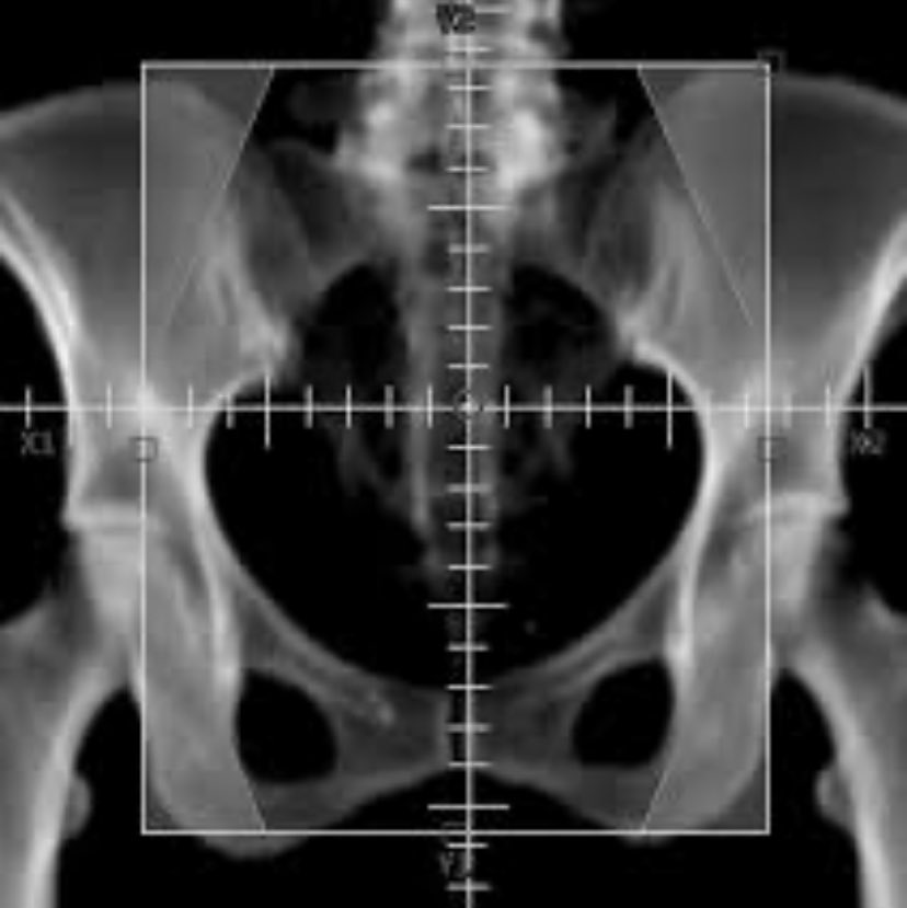 DrewMoghanaki's tweet image. Now is the time for all #radoncs to brush up on how to safely prescribe to the mid-plane. Recognizing many never learned this 2D technique.