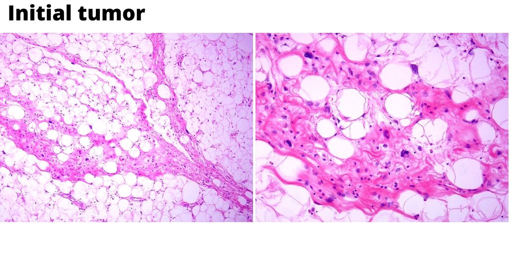 GeronimoJrLapac's tweet photo. ✅Back tumor recurrent 4 times.
✅An interesting case with pitfall alert from my routine !
✅Never give up on reviewing previous slides!
#bstpath #pathology https://t.co/6G8th7evyh