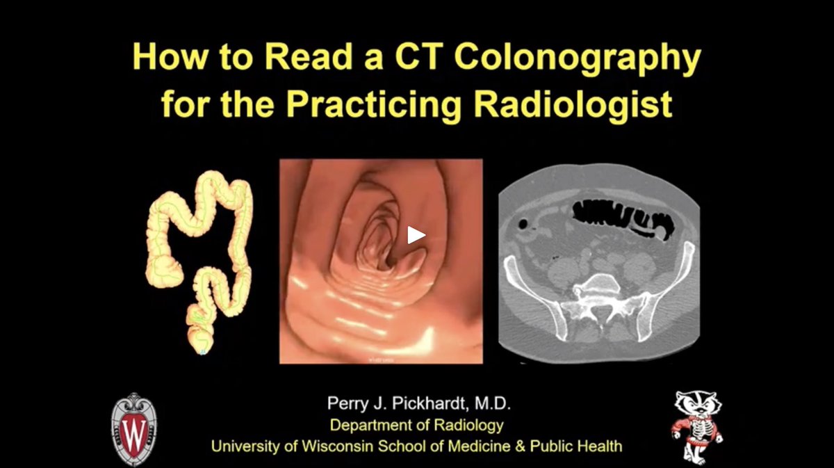 ISCTrad's tweet photo. The keys to accurate polyp detection with CT #colonography?
✔️Good technique
✔️Use an effective #CTC software that allows for 3D detection
✔️Redundancy
✔️Always confirm on 2D
Check out our free #radiology lecture of the month for more tips: https://t.co/G7tvKb1GnW https://t.co/zG1wxi24ye