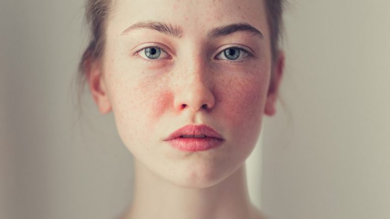 DrBusso's tweet photo. If you’re suffering from chronic red facial skin, contact dermatologist Dr. Mariano Busso at 305-857-0144 to discuss prevention, treatment, and living with rosacea. You may also schedule an appointment with Dr. Busso online.
https://t.co/xJwWeuA00t https://t.co/OcvFsvF614