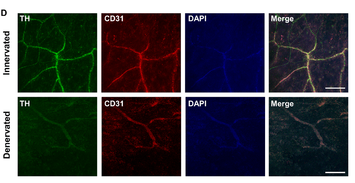 CircRes's tweet photo. #BoneMarrow sympathetic #neurons may be a new target for #hypertension treatment. 

A study in @CircRes now shows that blocking #sympathetic nerve-activity in BM prevents hypertension-associated #MemoryTcell accumulation. 
https://t.co/TWsvjUM3WZ https://t.co/V0OBYBMeca