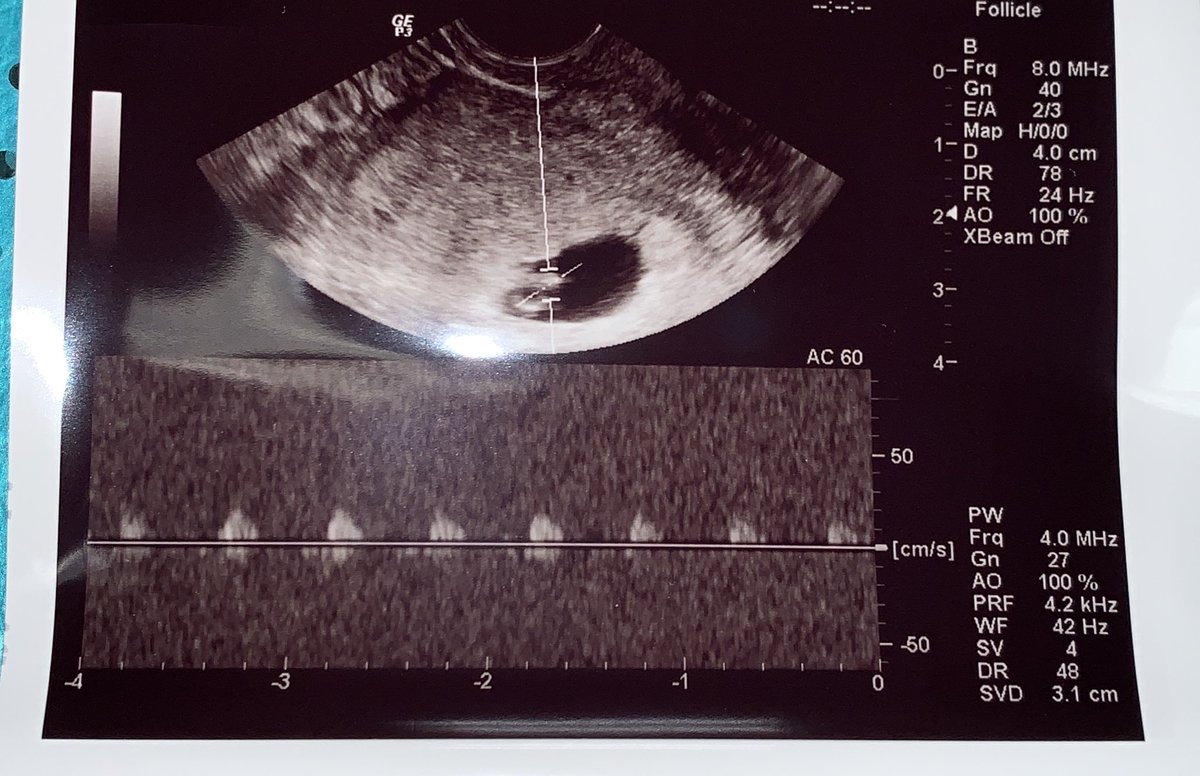 Primer bebé de la unidad de reproducción de <a href="/fertaid/">Equipo Dr. Pérez de la Blanca</a> en <a href="/quironsalud/">quirónsalud</a> durante el Covid-19. Esperamos que le vaya muy bien al chiquitín, y a su mamá. Después de todo esto, más. #fertilidad #teayudamos #quedateencasa