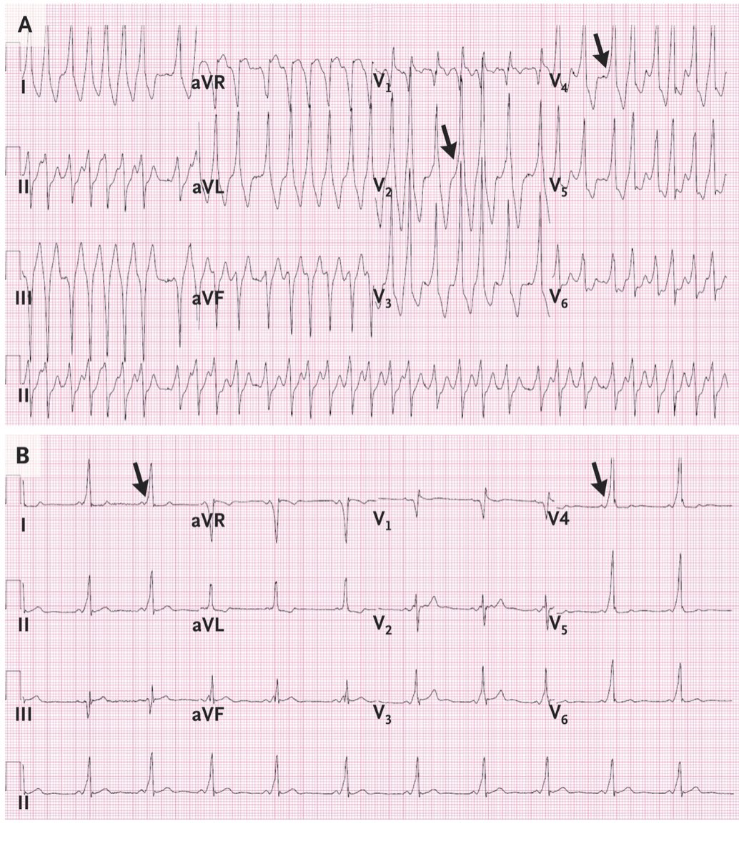 Atypical avnrt. фибрилляция предсердий на экг признаки. мерцательная аритмия на экг пароксизмальная форма. фибрилляция предсердий huawei. трепетание и фибрилляция предсердий на экг.