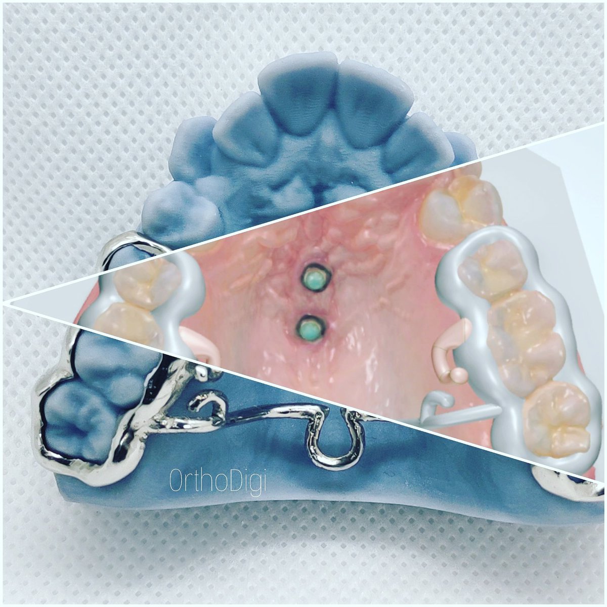 AydinKocdas's tweet photo. #hayatevesığar Bilgisayarımızı koyabilecegimiz her yer, çalışma ofisi 🤓
#DigitalHyrax #DigitalTPA #DigitalDentistry #Digitalorthodontics   
#ClearAligner #invisalign #dijitaldişhekimliği #dijitalortodonti   #orthodontist #orthodontics #ortodontist #ortodontiuzmanı #3shape #itero https://t.co/9J86z0xdC1