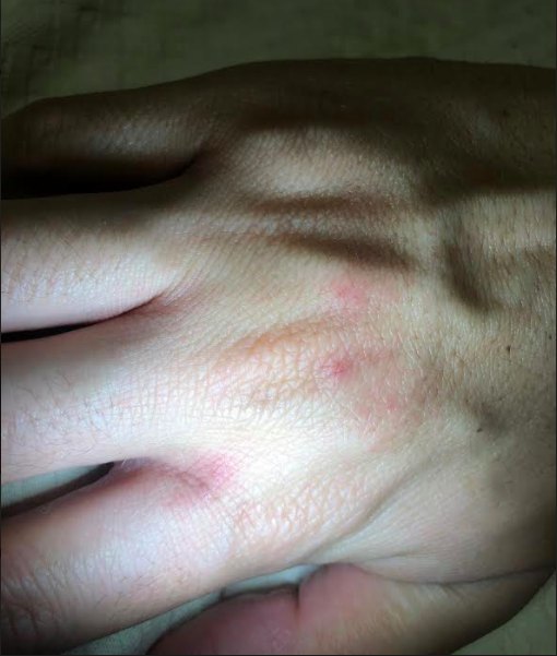 4/Lighting is key. Some tips:- Don't shine a light on the rash/lesion itself. The glare will be hard to see through (pic 1).- Normal ambient light is fine (pic 2).- Usually you shouldn't use flash.Check out my hand dermatitis from the constant handwashing as an example