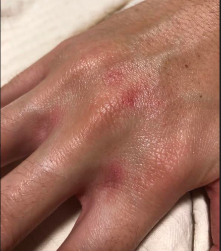 4/Lighting is key. Some tips:- Don't shine a light on the rash/lesion itself. The glare will be hard to see through (pic 1).- Normal ambient light is fine (pic 2).- Usually you shouldn't use flash.Check out my hand dermatitis from the constant handwashing as an example