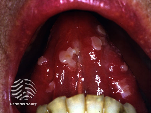 5/Take photos from far away (pic 1) & close up (pic 2). That way we can evaluate the distribution of the rash, but also see the primary lesion up close.Look in the mouth, eyes, & groin. Take a photo (pic3) if there's something! NB: The mouth might need a flash. pc:  @dermnetnz