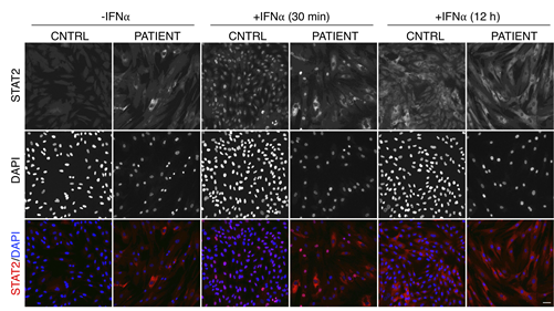 Journal of Experimental Medicine (@jexpmed) on Twitter photo Homozygous STAT2 gain-of-function mutation by loss of USP18 activity in a patient with type I interferonopathy bit.ly/2IDa2Ed by Conor Gruber, <a href="/casanova_lab/">Casanova Lab</a>, Dusan Bogunovic (<a href="/BogunovicLab/">BogunovicLab</a>), and colleagues Homozygous STAT2 gain-of-function mutation by loss of USP18 activity in a patient with type I interferonopathy bit.ly/2IDa2Ed by Conor Gruber, <a href="/casanova_lab/">Casanova Lab</a>, Dusan Bogunovic (<a href="/BogunovicLab/">BogunovicLab</a>), and colleagues