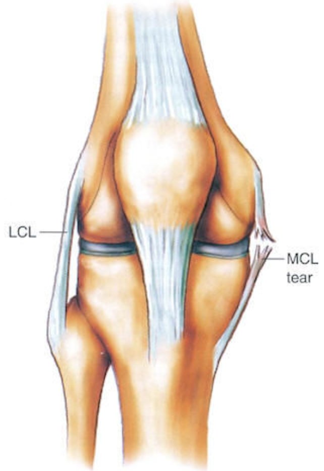 DrNikhilVerma's tweet image. #MCLinjuries account for approximately 24% of all #kneeinjuries &amp;amp; lead to pain, swelling &amp;amp; #kneeinstability. The #MCL is critical to knee stability so when it sustains a tear during a sports injury or during a fall. For more information: medilink.us/bnd8  #orthotwitter