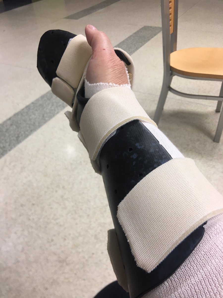 liznorris519's tweet photo. @GerryLaHay Was supposed to get a new smaller more functional cast tomorrow at @stjosephslondon #postponed #brokehand I’ll live...I’m thankful ❤️ https://t.co/avNtm4g8UB