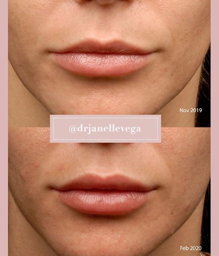 #GlowUp your lip game from top to bottom. Our filler technique eliminates the potential for temporary lumpiness and reduces any swelling or redness in the area. Visit soo.nr/HCrf for more information so you can love your lips for longer. 💋 #MayoralDerm #LoveYourSkin