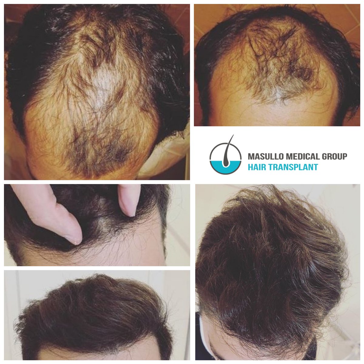 hairtra_masullo's tweet photo. #fue #hairtransplant 14 months later.
#hairtransplantation is the only #hairrestoration solution offering permanent results. The #fuemethod (with no visible scars and no stitches) surpassed what medications and #hairlosstreatments alone can do to treat #hairlossproblems➡️🌐 📧📲 https://t.co/ngeONiAt0A