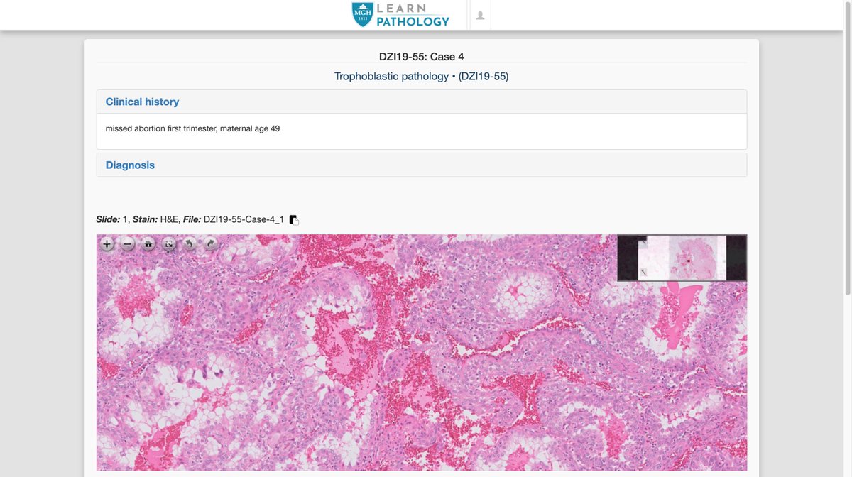 MGHPathology's tweet image. As residency programs begin to adopt #RemoteLearning initiatives, we hope you will find our digital slide repository valuable. Hundreds of annotated cases across a wide range of diagnostic entities: learn.mghpathology.org/index.php/Stud…