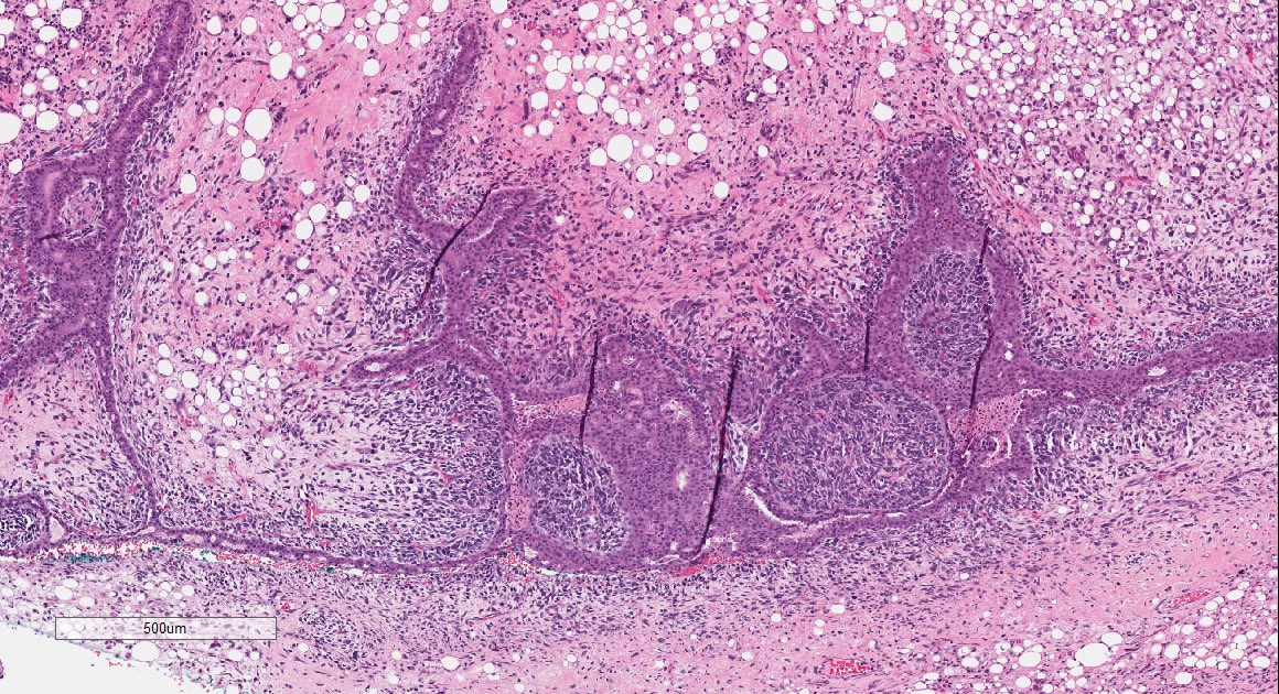 gtevaristomd's tweet photo. Since we all need a tiny bit less of stress &amp; a tiny bit more of educational material, I thought I would share with you this beauty.. *Middle-age F, breast Bx*
#BreastPath #SurgPath https://t.co/PkwAFu8V1N