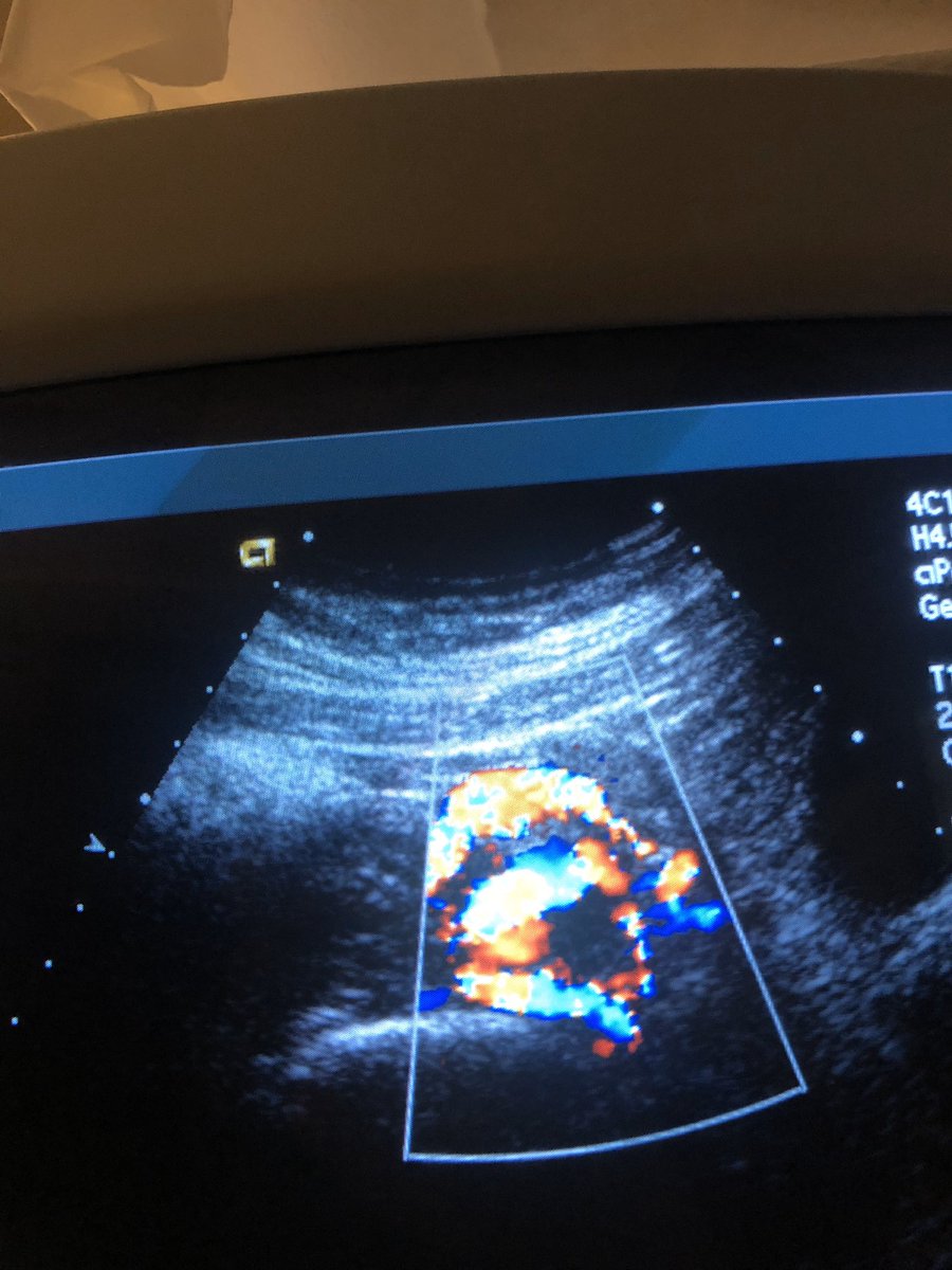 So idk what it is but I can find the ring of fire so easy #ultrasoundstudent