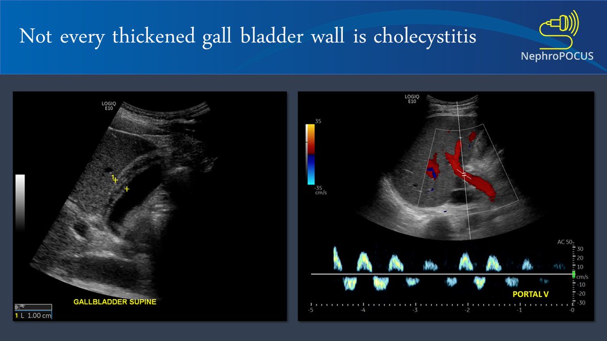 NephroP's tweet photo. Thickened gall bladder wall + abnormal LFTs ≠ cholecystitis. These images are from a patient with #HeartFailure exacerbation and no abdominal pain. Portal vein is pulsatile with systolic flow reversal indicating severe congestion. GB wall thickening is due to CHF #POCUS #IMPOCUS https://t.co/u0nz7nmX5e