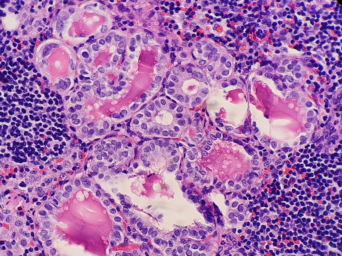fairuz_rahman's tweet photo. Incidental finding of Mets Papillary Thyroid Ca in cervical LN (Neck dissection for tongue SCC).
TRO occult thyroid CA
Ectopic malignancy?
#headandnecktumour
#HNSCC
#ThyroidCA https://t.co/pn7zaXO6X1