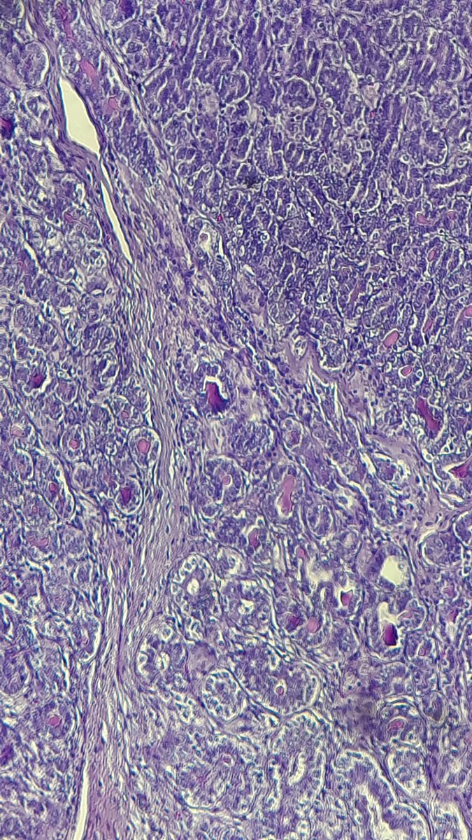 drsofa's tweet photo. Dear colleagues, a case from 16 yo female, right breast, 4 cm.
Looking foward for your favourable ddx. Thankyou.
#breastpathology #pathology
#pathologycase
@Kashifhazim @PathologyTweet @GeronimoJrLapac https://t.co/MdPlsQAbzn