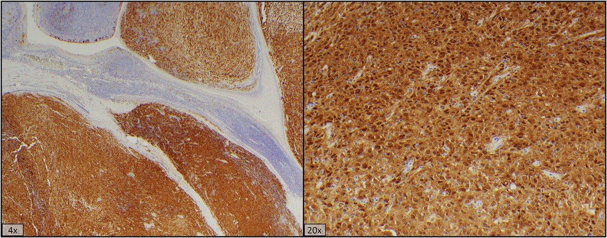 A cool p16+ Cancer of the tonsil... but its not SCC!

Tonsillar p16-Positive Follicular Dendritic Cell Sarcoma Mimicking HPV-Related Oropharyngeal Squamous Cell Carcinoma