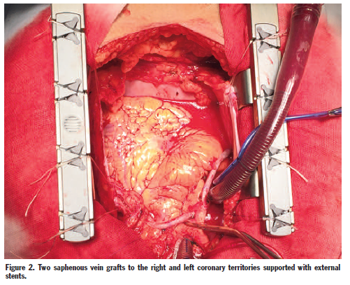 SurgicalTechSTI's tweet photo. External Stents for Vein Grafts in
Coronary Artery Bypass Grafting:
Targeting Intimal Hyperplasia LP Weltert, MD Ruggero dePaulis, MD https://t.co/CXG4Z4IKxd https://t.co/1rj5cit39q