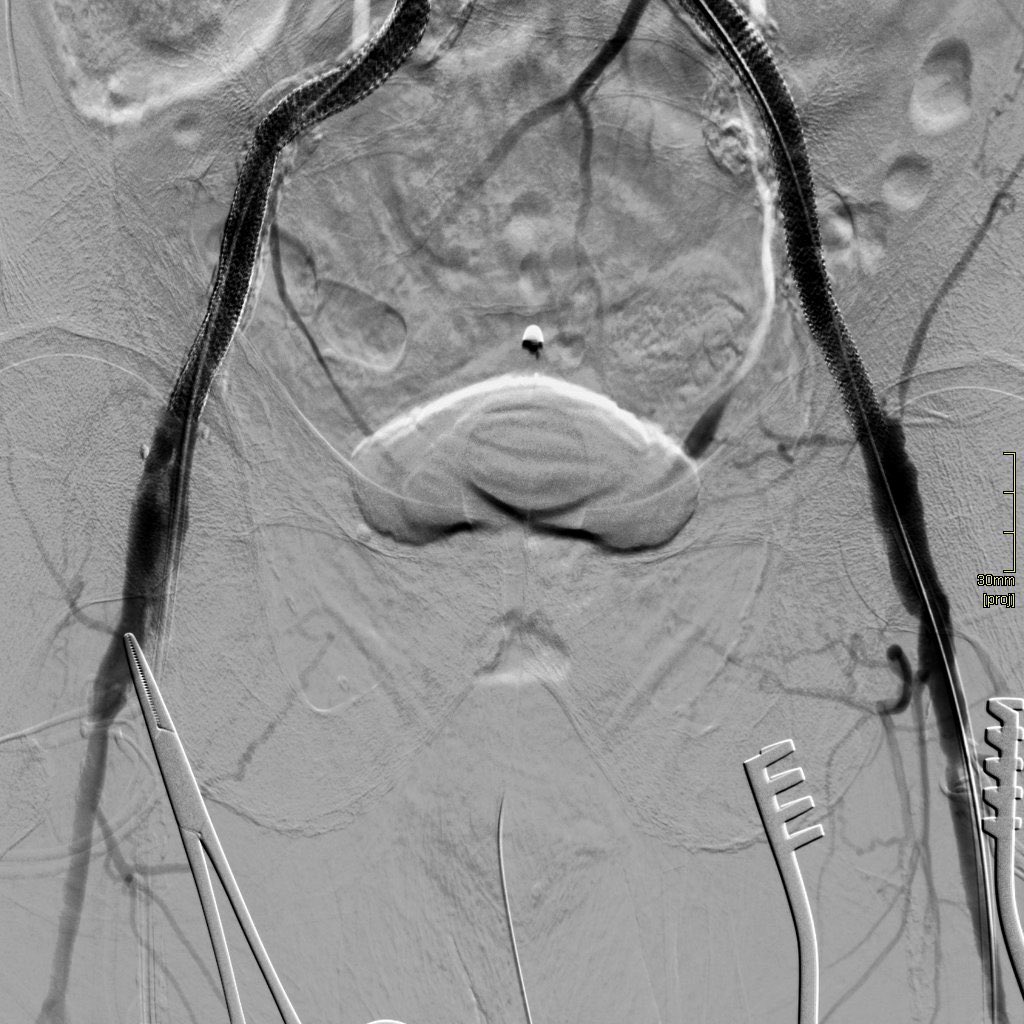 Subintimal recannalisation and stenting (CERAB technique) by <a href="/ZaidAHAldin1/">Zaid A H Aldin</a>. Complicated by embolisation to R Fem A, Rx’d by embolectomy. Stents extended bilaterally to inguinal’s with good result.