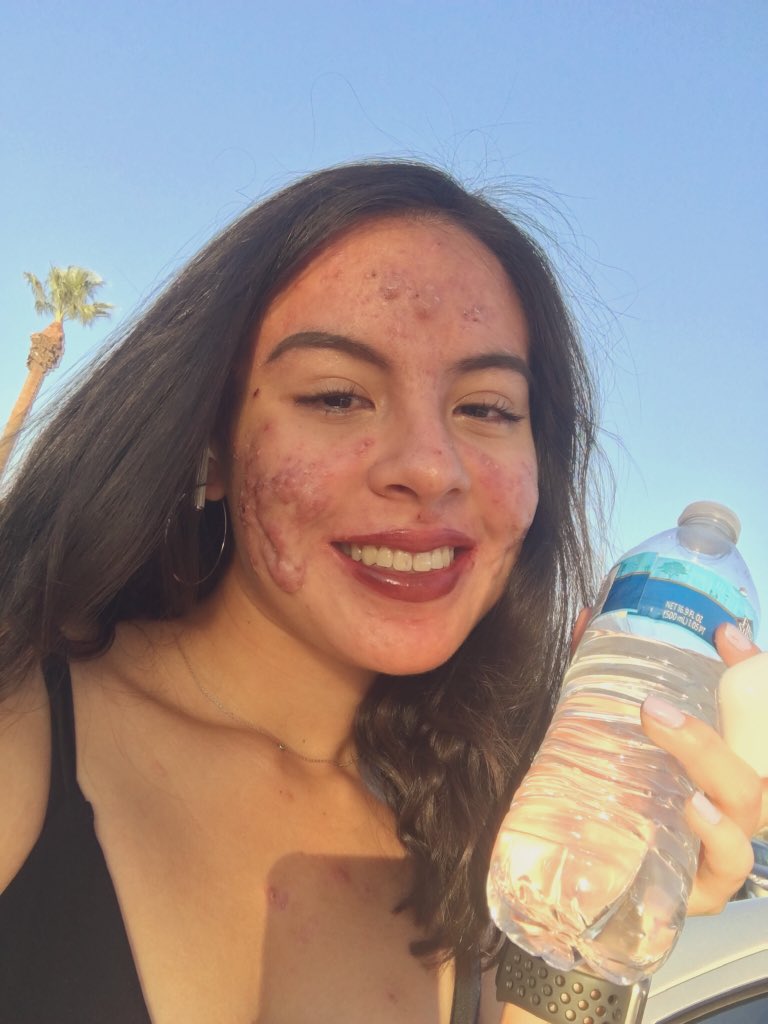 jjacckkss's tweet image. Long story short, Accutane. Severe cystic acne vulgaris. Long journey from June-Feb. Depression, suicidal thoughts, social distancing, appetite loss, aching body, dry skin, &amp;amp; hair loss. I’ve been through a lot these 8 months. Hated every single moment. Sorry for being ugly!