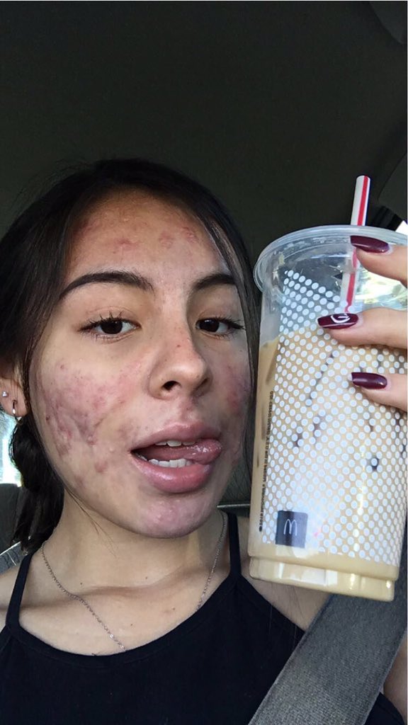 jjacckkss's tweet image. Long story short, Accutane. Severe cystic acne vulgaris. Long journey from June-Feb. Depression, suicidal thoughts, social distancing, appetite loss, aching body, dry skin, &amp;amp; hair loss. I’ve been through a lot these 8 months. Hated every single moment. Sorry for being ugly!