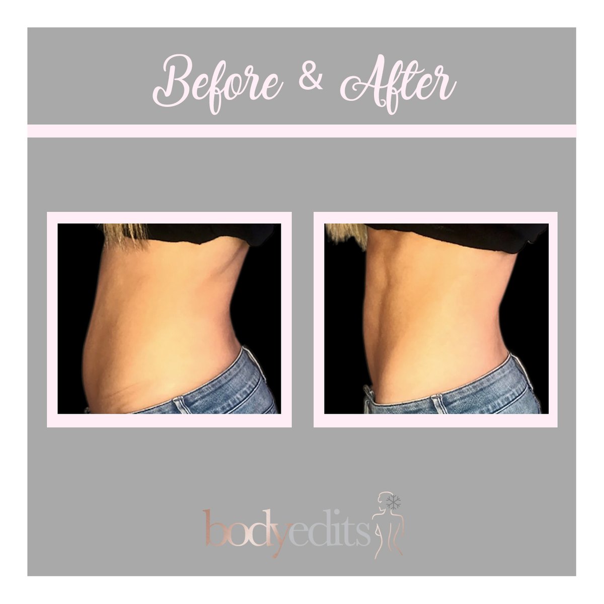Sadaf_Jaffari's tweet photo. WOW! These results definitely speak for themselves. Yet another fantastic before/after picture from EMSculpt.
#emsculpt #bodysculpting #gains https://t.co/oCGFuEpcCk