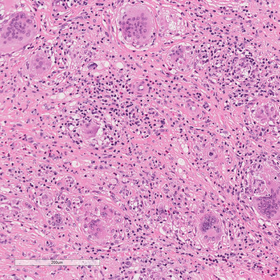MSeidmanMD's tweet photo. What's your diagnosis? @SCVP1 #pathology https://t.co/F39uWpLN98