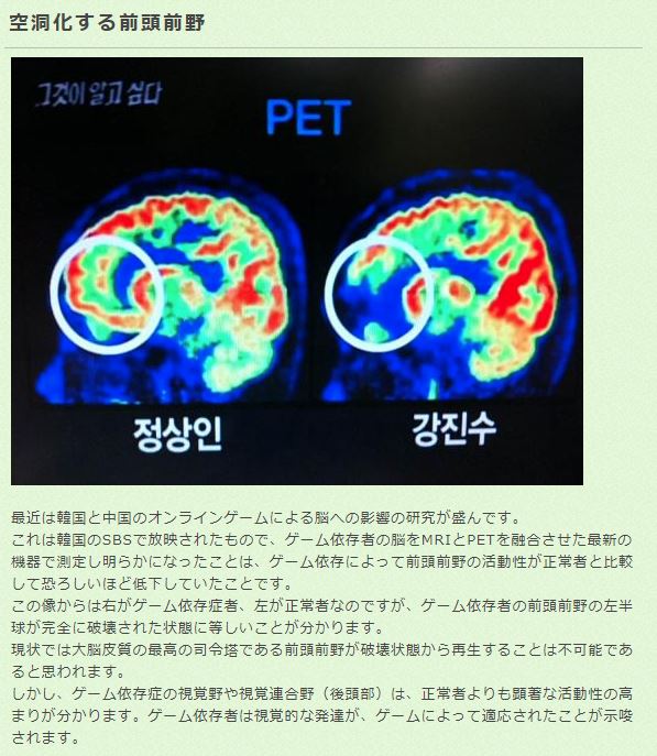 発達障害とゲーム依存症が合併することが多いってあるけど ゲーム依存症の正体って Togetter