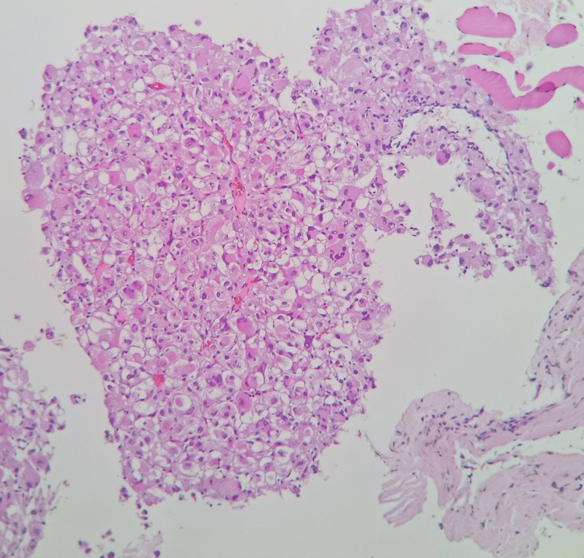 MAHoureih's tweet photo. #pathology Large left hypochondriac abdominal mass in an early twenties poor lad. What would be your initial DDx and IHC panel? 🤔 🧐 Two sets of images below https://t.co/7GoiOfrSaM