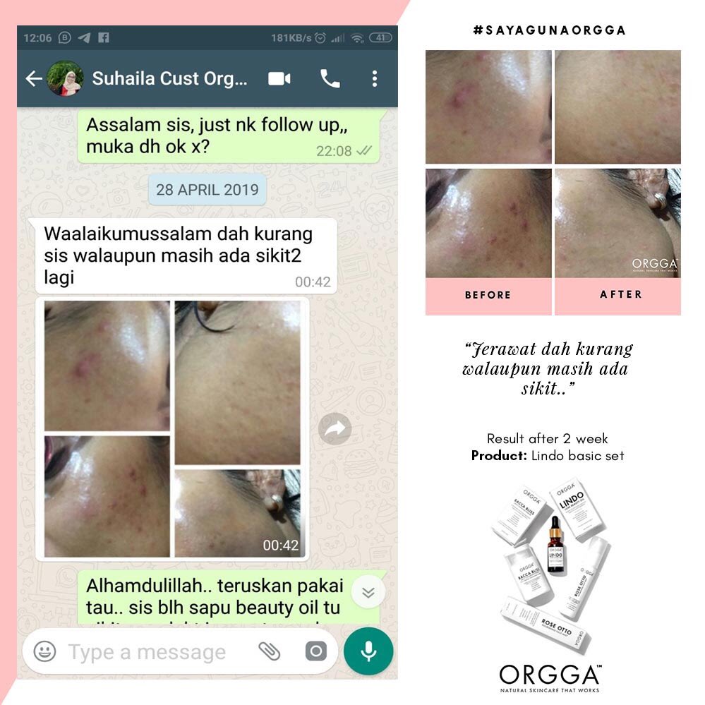 OrggaMalaysia's tweet photo. #OrggaFeedback | "Jerawat dah kurang walaupun masih ada sikit2 lagi" - sis Suhaila . Lindo Basic Set memang sangat sesuai untuk orang kulit berminyak dan berjerawat 😘 https://t.co/GPcdE0m71c